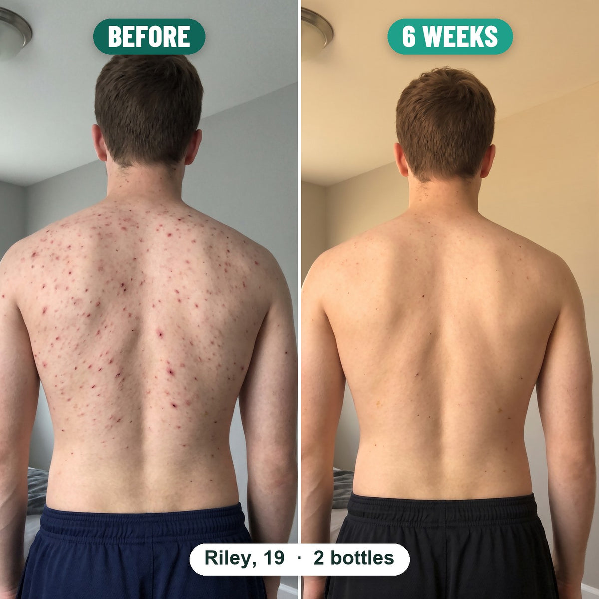 Riley, 19: his back before and 6 weeks after using Grom, 2 bottles