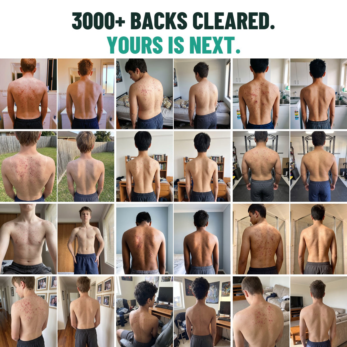 3000+ backs cleared. Yours is next. Twelve teenage boys' backs before Grom and after, clear of acne.