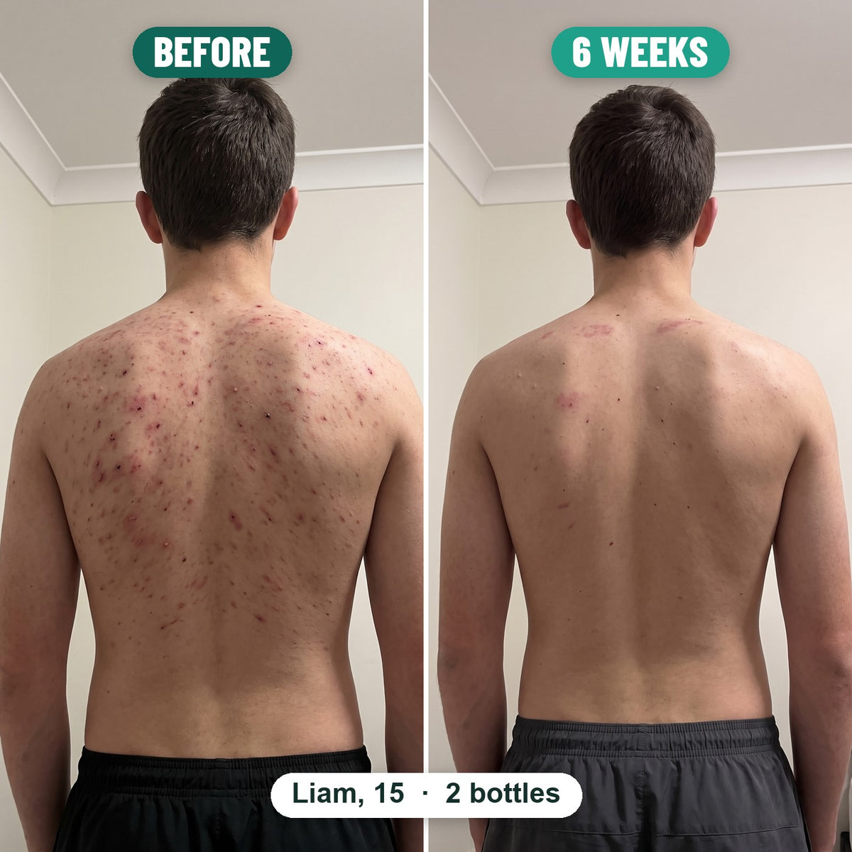 Before and after: Liam, 15, back acne before Grom and 6 weeks later on 2 bottles