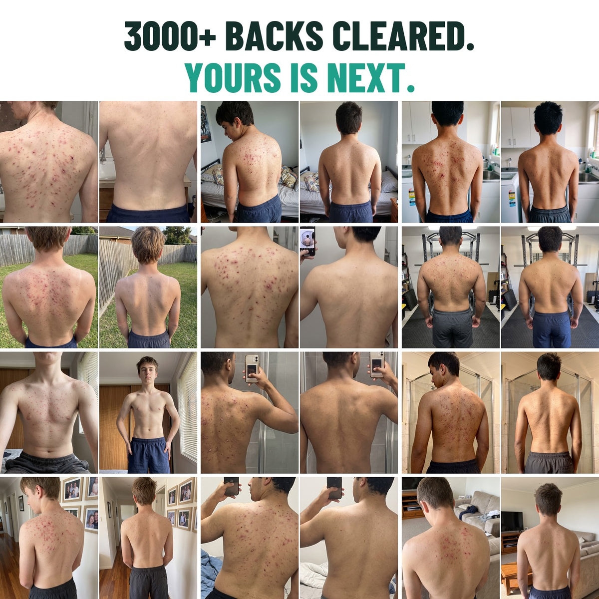 3000+ backs cleared, yours is next: a wall of 12 back acne before and after photos
