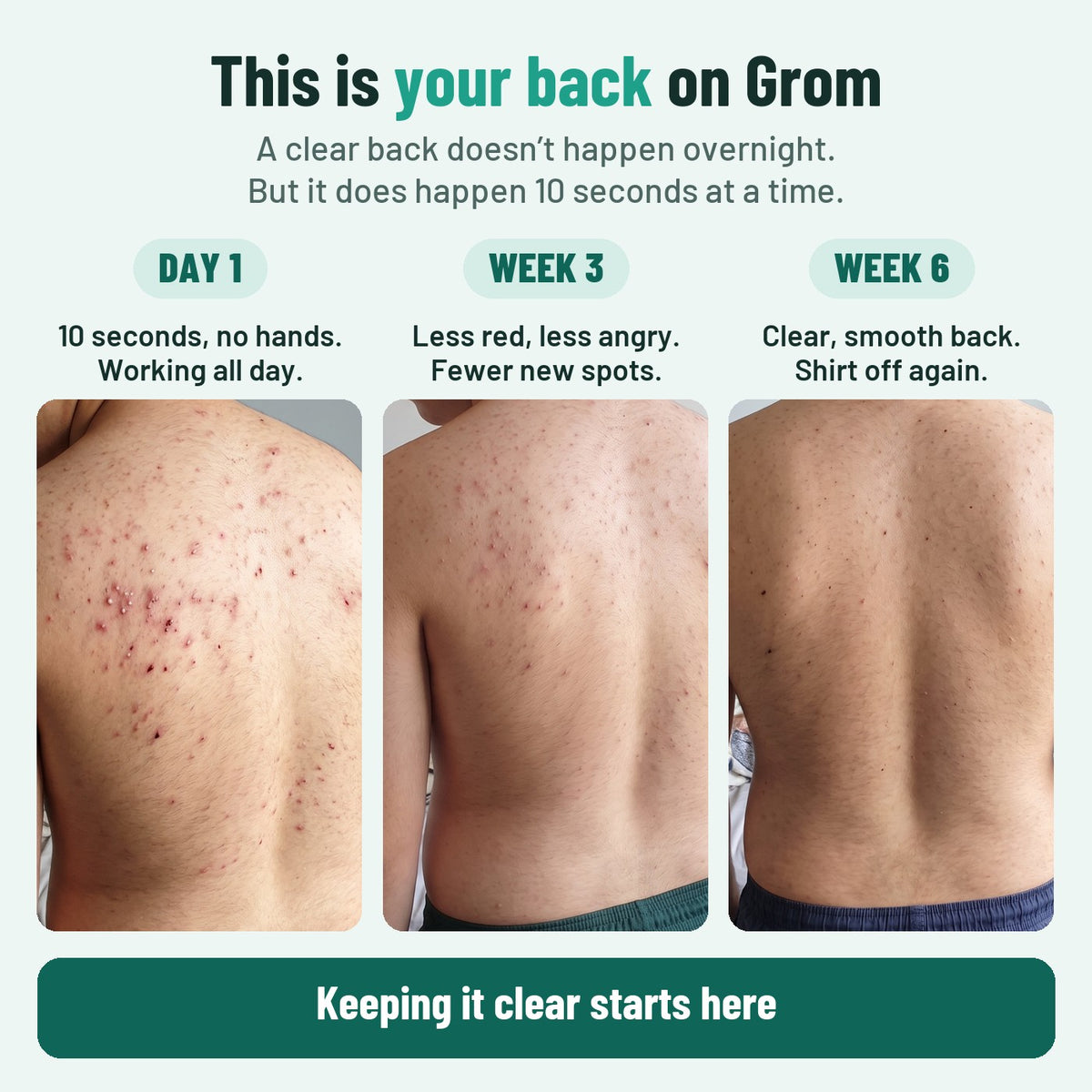 This is your back on Grom: day 1, week 3 and week 6 back photos going from acne to clear
