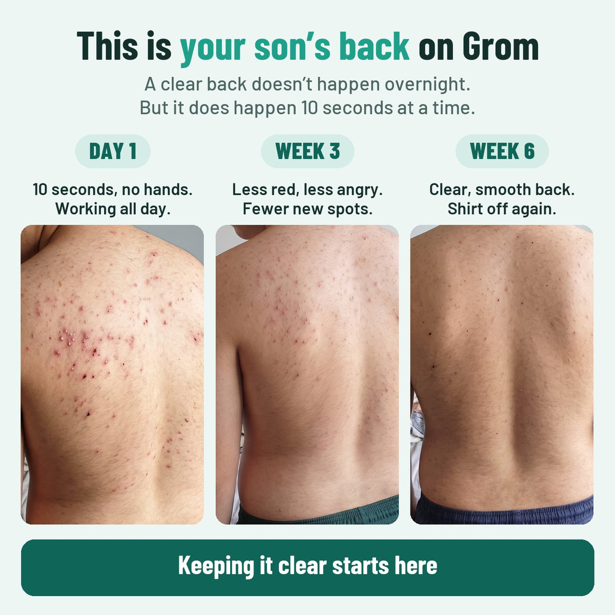 This is your son's back on Grom. Day 1: 10 seconds, no hands, working all day. Week 3: less red, less angry, fewer new spots. Week 6: clear, smooth back, shirt off again. Keeping it clear starts here.