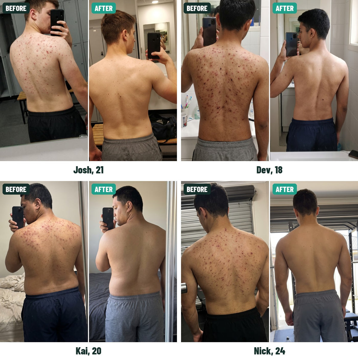 Before and after back acne photos of four young men: Josh, 21; Dev, 18; Kai, 20; Nick, 24