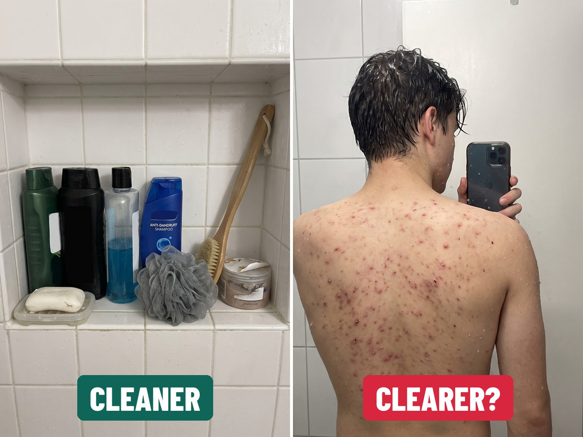 A shower shelf full of body washes, shampoo and scrubbers labelled cleaner, next to a freshly showered back still covered in acne labelled clearer?