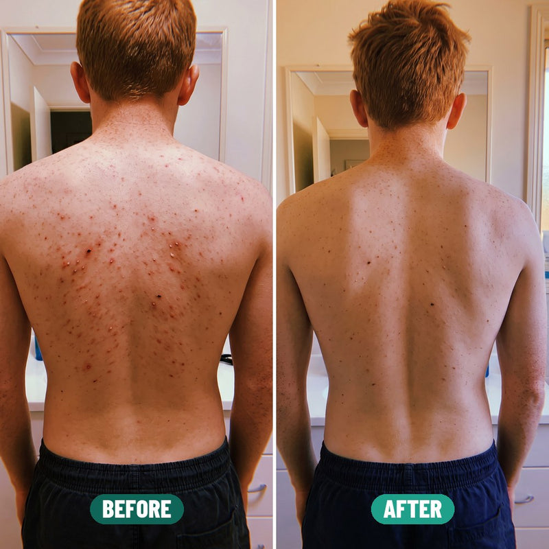 Harry, 14: back acne before Grom and after
