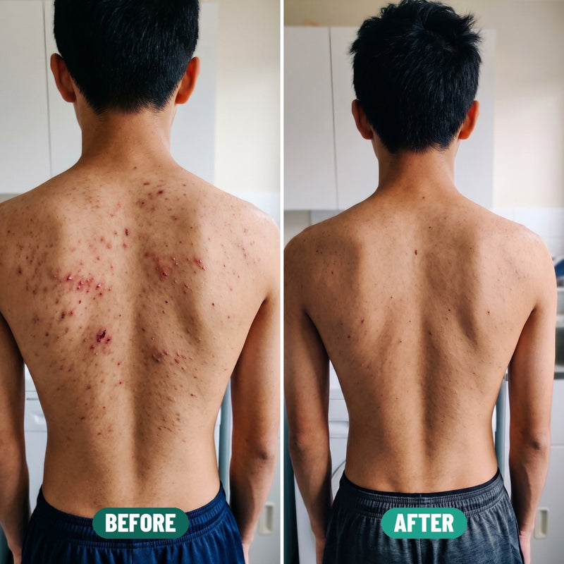 Arjun, 16: back acne before Grom and after