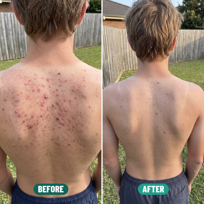 Cooper, 17: shoulder acne before Grom and after