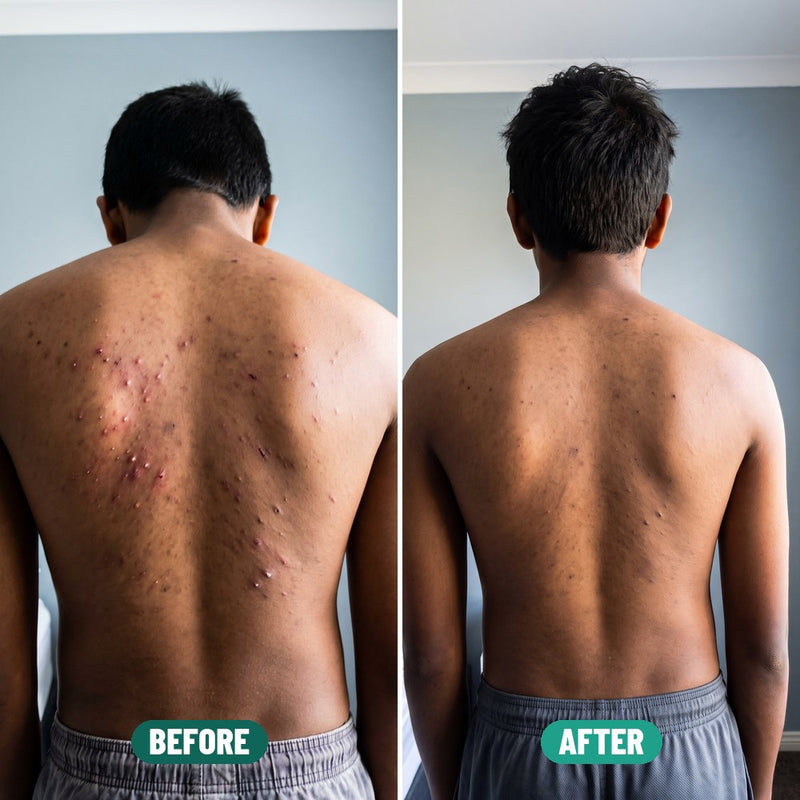 Kofi, 14: back acne before Grom and after