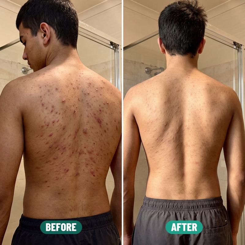 Luca, 17: back acne before Grom and after