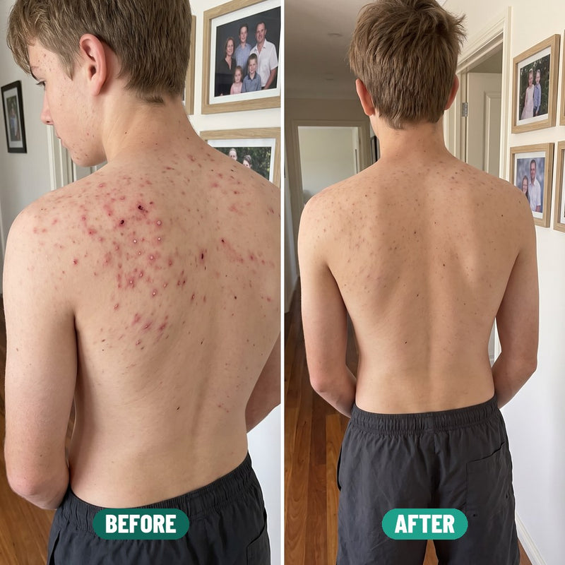 Noah, 16: shoulder acne before Grom and after